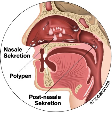 Nasenpolypen | Novartis Österreich
