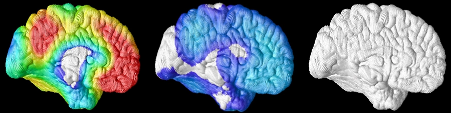 Amyloid-Ablagerungen