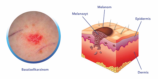 Melanom
