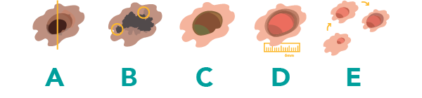 Muttermale
