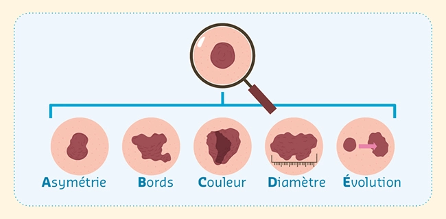 Melanoma color change