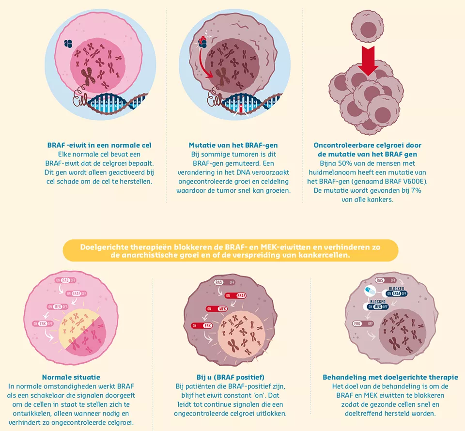 Infographic Melanoma