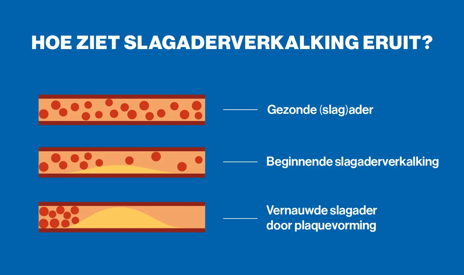 Infographic slagaderverkalking