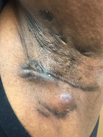 стадий 1 на Хърли 