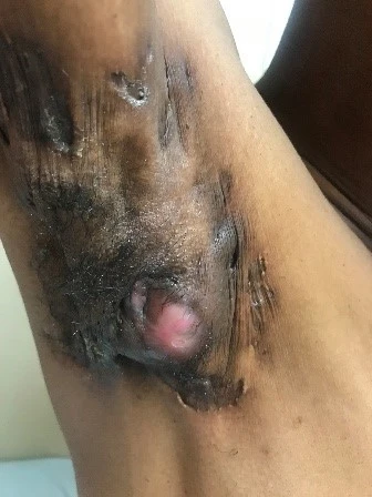 Стадий 3 на Хърли