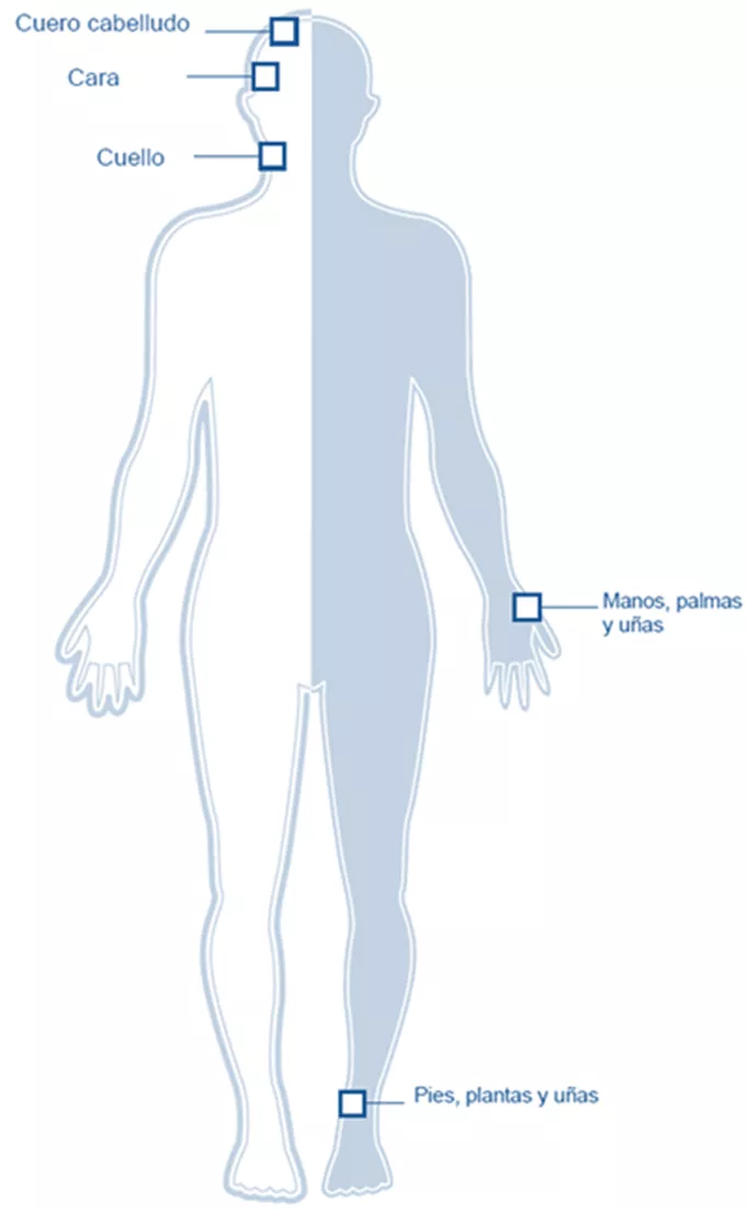 Zonas que afecta la psoriasis