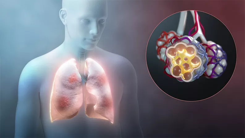 Immunüberreaktion des Körpers mit Auswirkung auf die Lunge