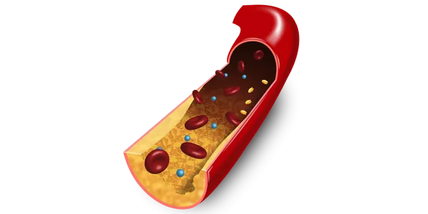 3D Illustration von Fettablagerungen in Arterien/ Illustration 3D des dépôts de graisse dans les artères