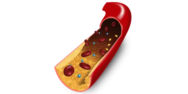 3D Illustration von Fettablagerungen in Arterien/ Illustration 3D des d&eacute;p&ocirc;ts de graisse dans les art&egrave;res