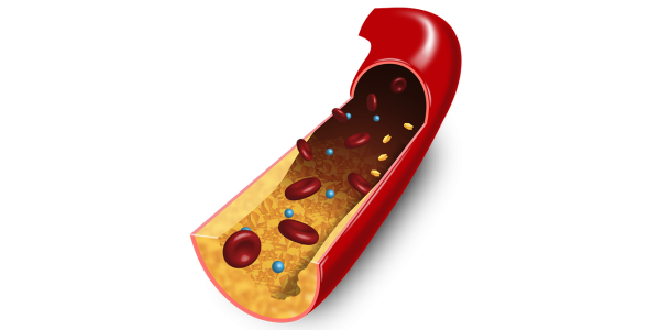 3D Illustration von Fettablagerungen in Arterien/ Illustration 3D des dépôts de graisse dans les artères