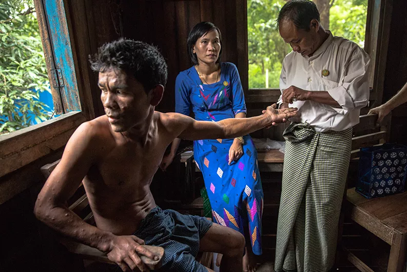 Un patient atteint par la lèpre est examiné au Myanmar