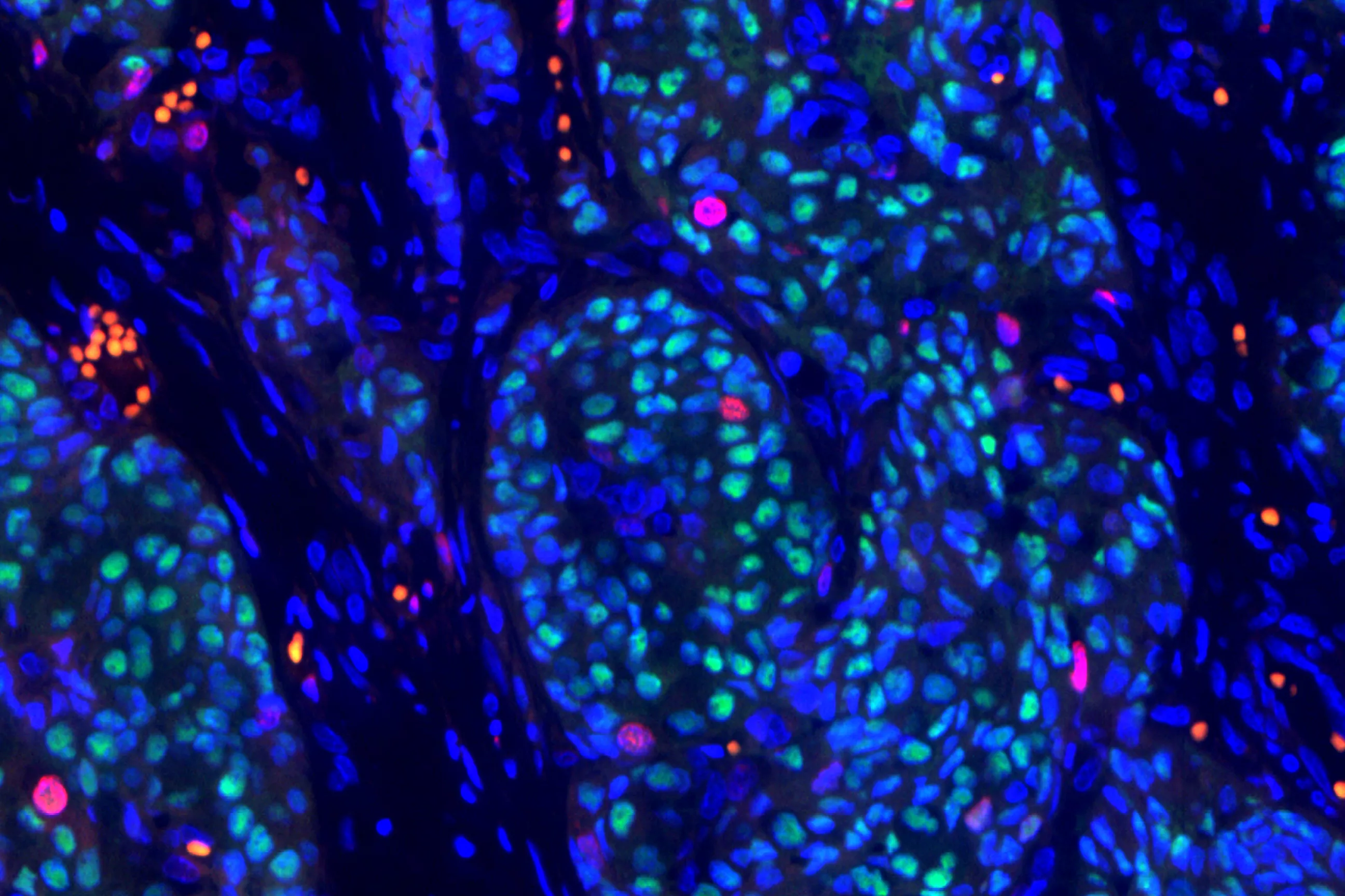 Brustkrebszellen unter dem Mikroskop / Cellules cancéreuses du sein vues au microscope