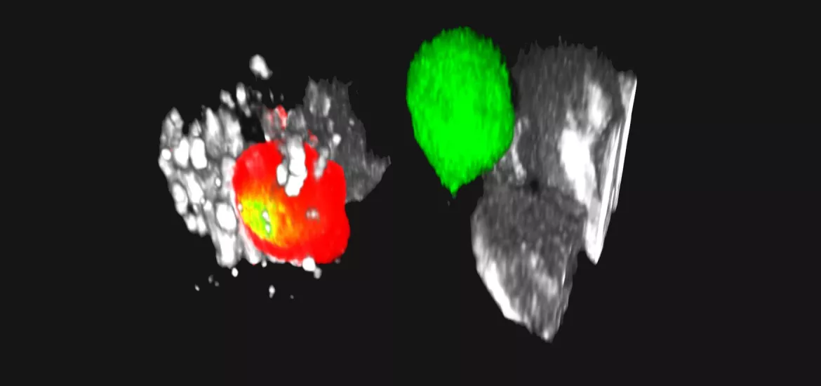 Eine CAR-T Zelle (grün) attackiert ein Myelom (grau). Ein roter Farbstoff dient als Indikator für den Tod der erkrankten Zelle. / Une cellule CAR-T (verte) attaque un myélome (gris). Un colorant rouge sert d'indicateur de la mort de la cellule malade.