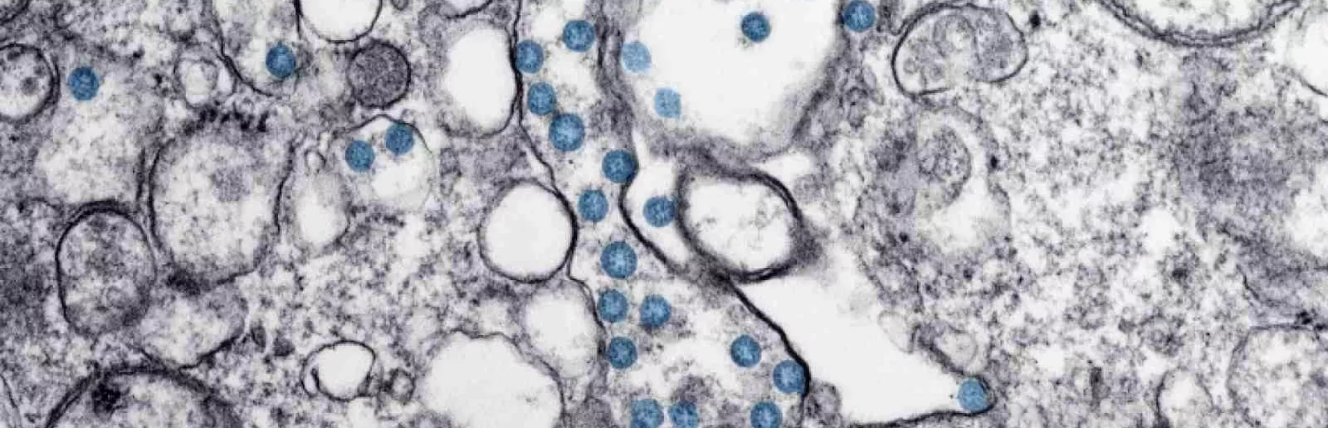 Částice viru SARS CoV 2 na snímku z elektronového mikroskopu.