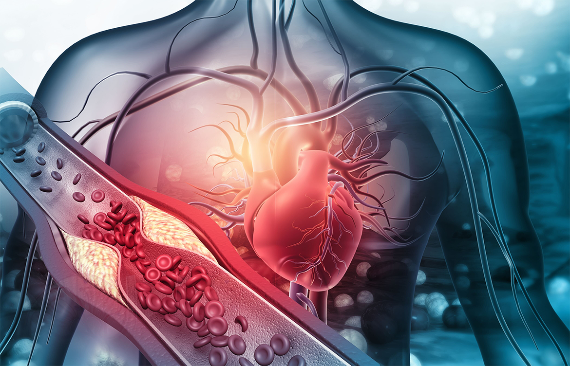 Schematische Darstellung des menschlichen Gefäßsystems. Im Vordergrund eine vergrößert dargestellte Arterie, die aufgrund einer Fettablagerung verengt ist.