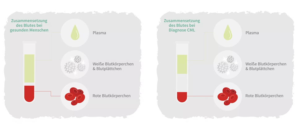 Unterschiede bei der Zusammensetzung des Blutes bei CML-Betroffenen und gesunden Menschen.