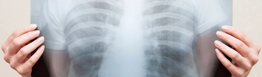persona sujetando una radiografía de su caja torácica