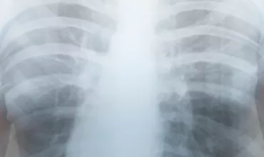 persona sujetando una radiografía de su caja torácica