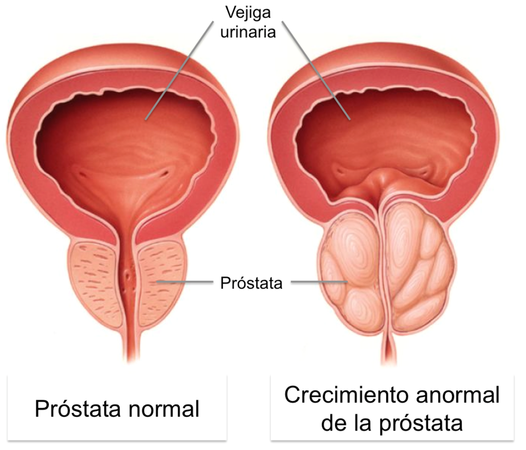Imágenes de próstata normal y con crecimiento anormal