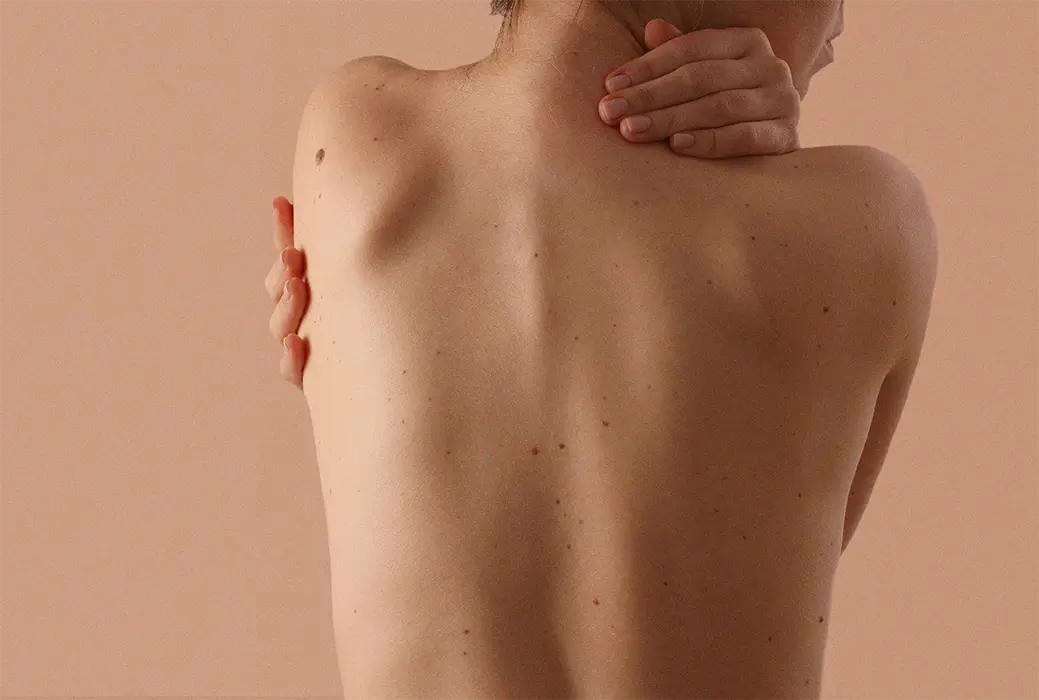 Aksiaalisen spondylartriitin oireet ja diagnoosi