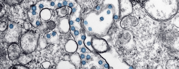  Image au microscope d'un cas de COVID-19