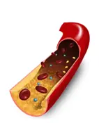 αρτηρίες ASCVD