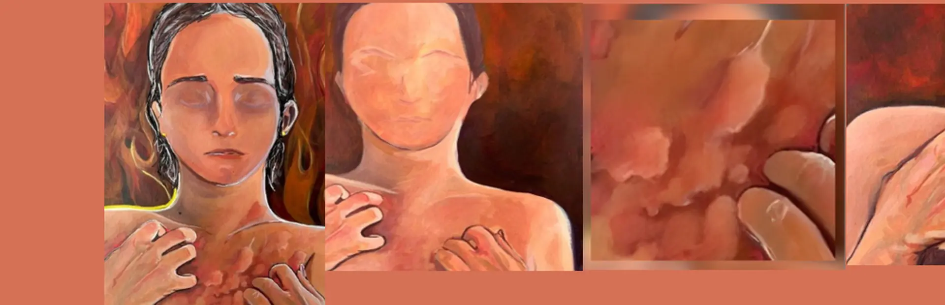 Share your experience of living with Chronic Spontaneous Urticaria (CSU)