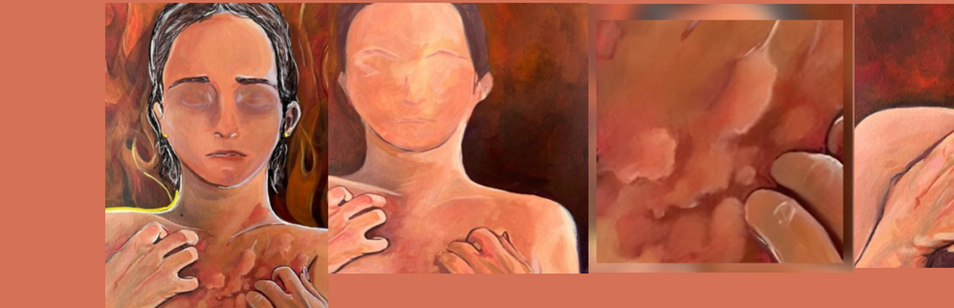 Share your experience of living with Chronic Spontaneous Urticaria (CSU)