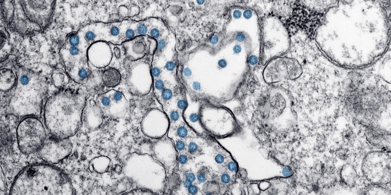 Transmission electron microscopic image of an isolate from a case of COVID-19