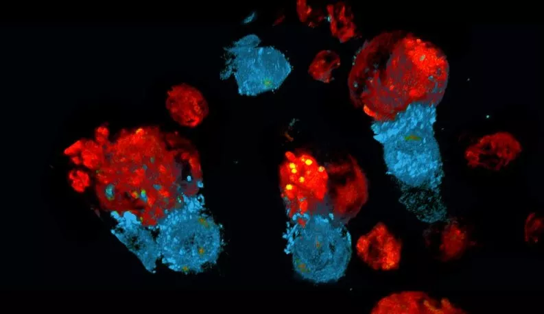 Células CAR-T a atacar células cancerígenas