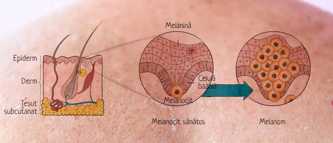Melanomul este o formă de cancer cu evoluție agresivă, care se dezvolta cel mai adesea la nivelul pielii și poate să apară la orice vârstă.