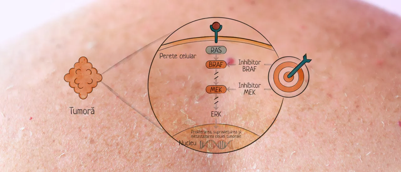 Tipuri de terapii utilizate în melanom