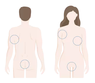 Illustration av vanliga ställen på kroppen som HS uppkommer
