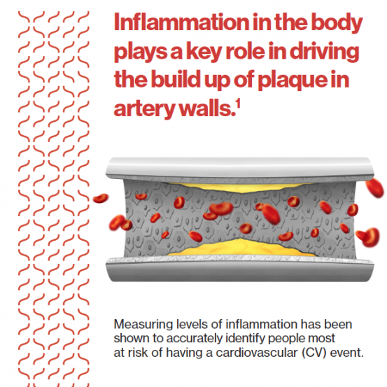 Measuring levels of inflammation has been shown to accurately identify people most at risk of having a cardiovascular (CV) event.