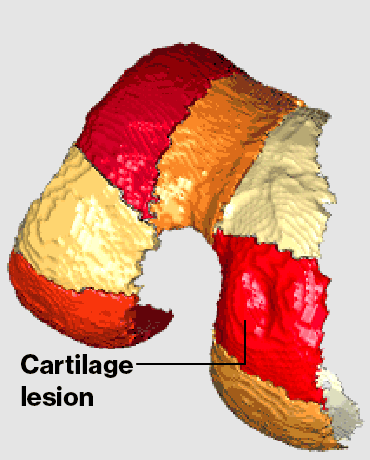 Advanced magnetic resonance imaging (MRI) showing cartilage regeneration in the knee.