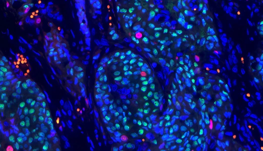 Breast cancer cells