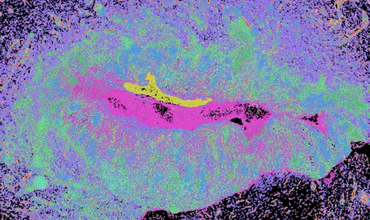 Hidradenitis Suppurativa skin