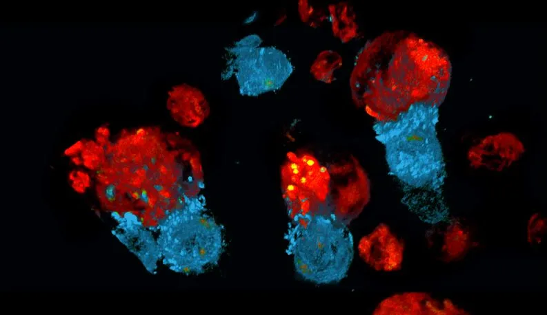 CAR-T cells attacking cancerous B-cells