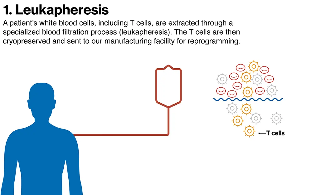 Leukapheresis