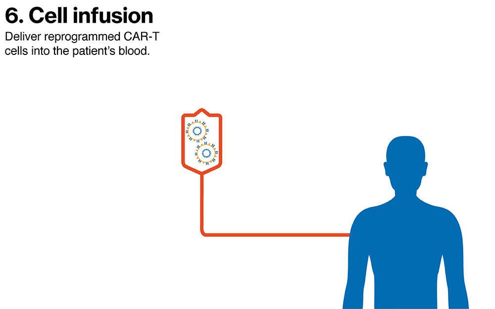 Cell Infusion
