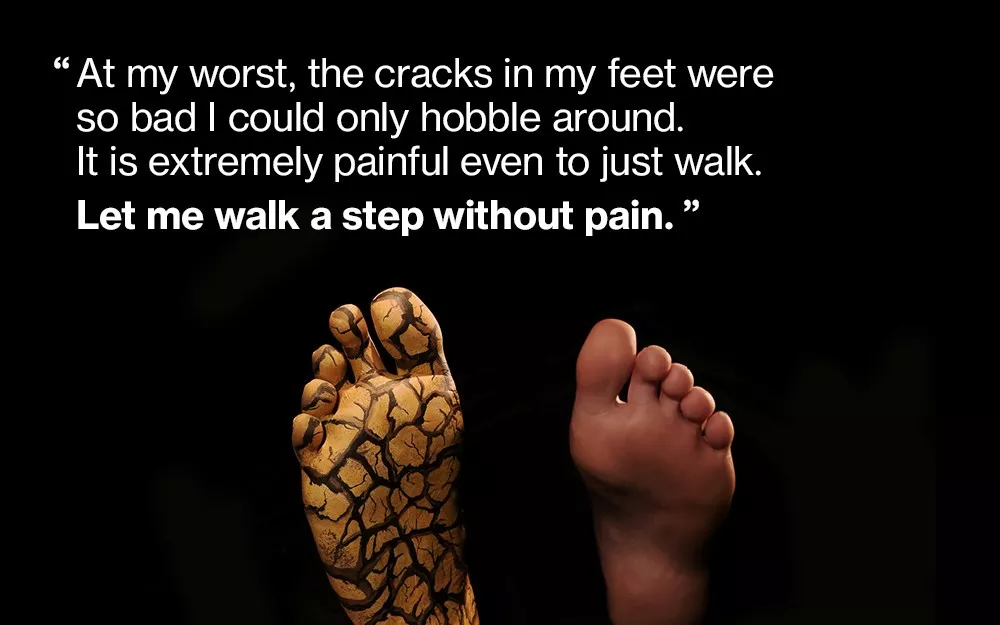 Artistic rendering of cracks on a psoriasis patient's foot