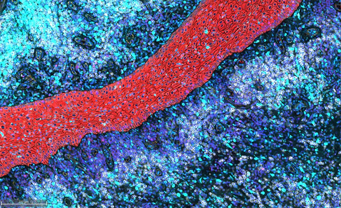 Multiplex immunofluorescence staining illustrating intradermal sheets of migrating stratified squamous epithelium and associated inflammatory response in Hidradenitis suppurativa.