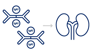 IgA1-containing immune complexes depositing in the kidneys