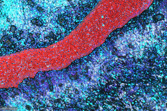 Multiplex immunofluorescence staining illustrating intradermal sheets of migrating stratified squamous epithelium and associated inflammatory response in Hidradenitis suppurativa.