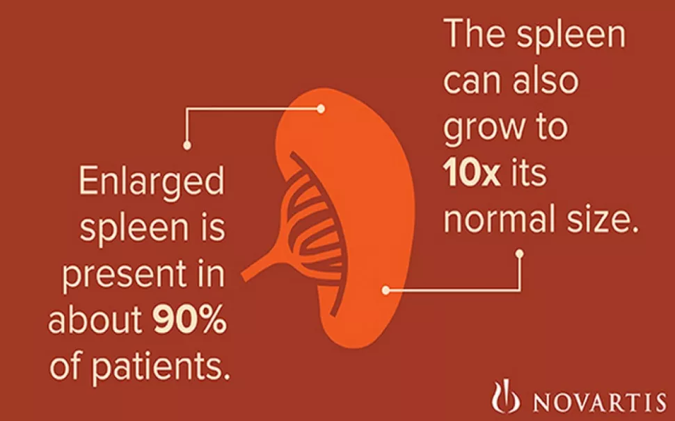 Enlarged spleen infographic