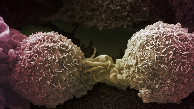 Lung cancer cells by Ann Weston, LRI, CRUK, Welcome Images Lung cancer cells by Ann Weston, LRI, CRUK, Welcome Images