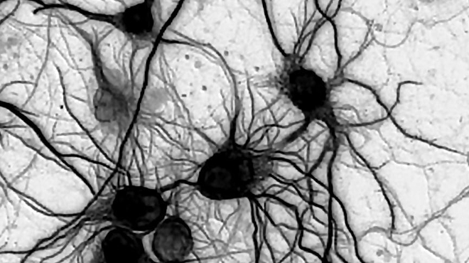 Electrical brainstorms traced to genetic mutations Electrical brainstorms traced to genetic mutations