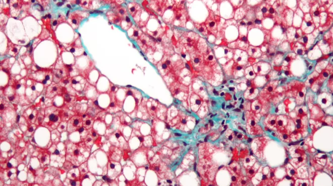  Leveraging the liver’s ability to heal scarred tissue
