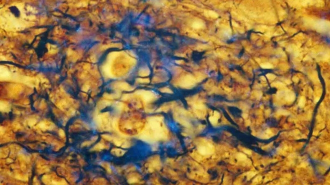 Stopping Alzheimer's disease before it starts