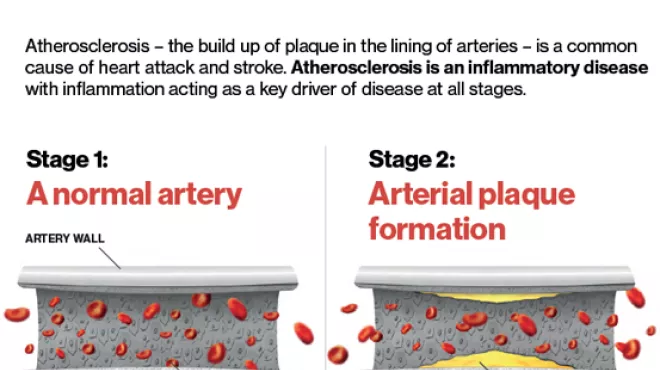 Atherosclerosis – the build up of plaque in the lining of arteries – is a common cause of heart attack and stroke